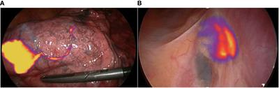 What is the appropriate “first lymph node” in the era of segmentectomy for non-small cell lung cancer?
